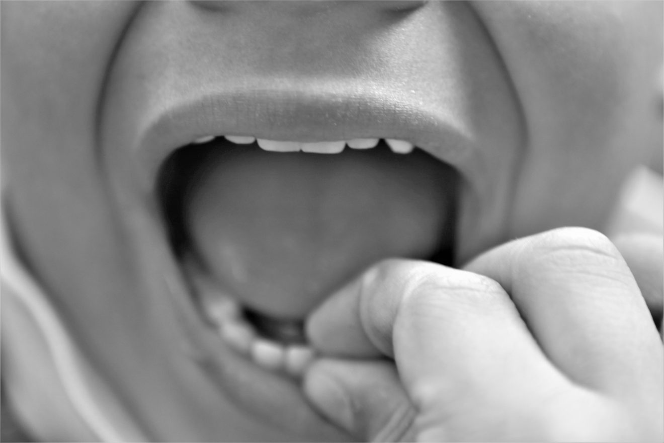 HK Kommunal: Klinikassistenter kan afhjælpe tandlægemangel